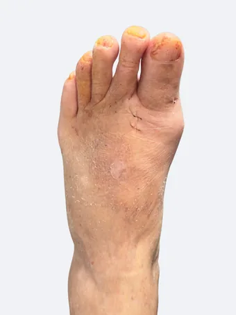 Left foot 16 days after bunion and hammertoe correction