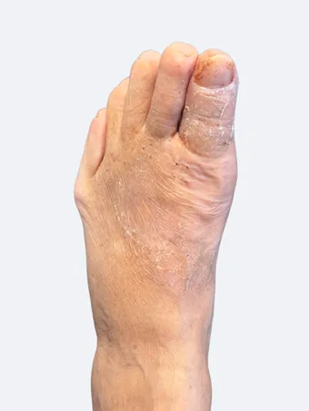Left foot 22 days after bunion and hammertoe correction