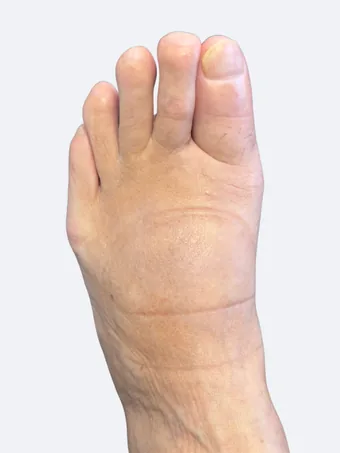29 days after bunion correction