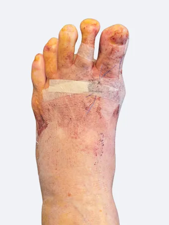 Left foot 48 hours after bunion and hammertoe correction