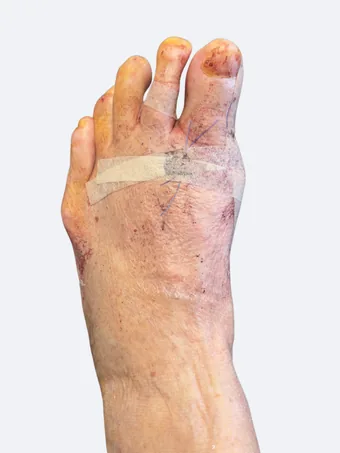 Left foot 9 days after bunion and hammertoe correction