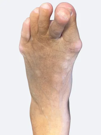 Bunion before surgery