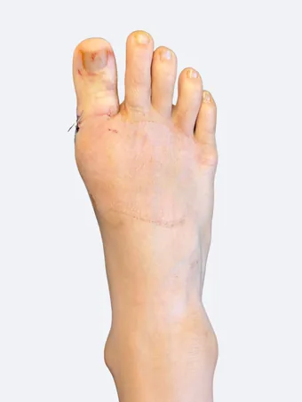 Right foot 15 days after bunion correction