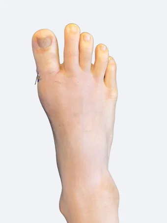 Right foot 22 days after bunion correction showing corrected alignment with sutures