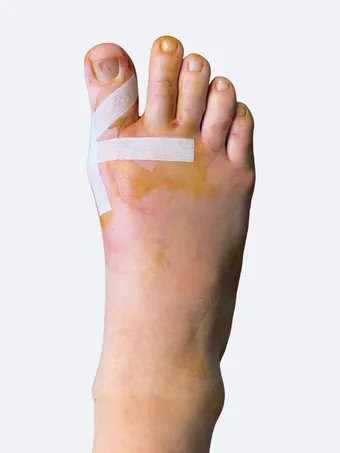 Right foot 2 days after bunion correction