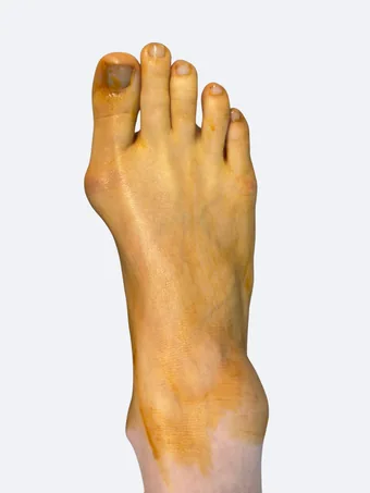 Right foot bunion deformity day of surgery with Betadine prep