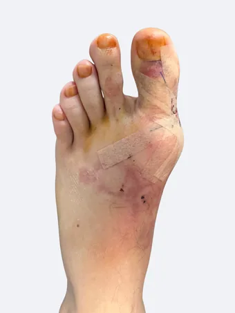 Left foot 48 hours after bunion correction showing improved alignment