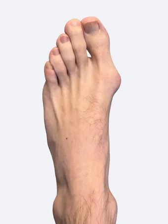 Left foot bunion deformity before surgery in male patient