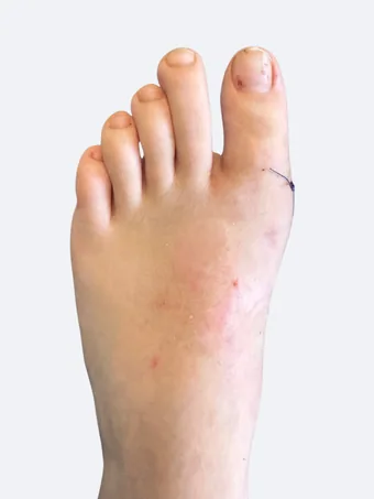 Left foot 13 days after bunion correction showing healing progress
