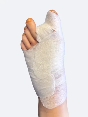 Left foot 2 days after bunion surgery with dressing