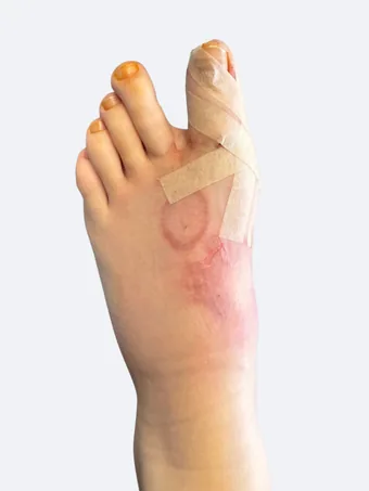 Left foot 2 days after bunion surgery dressing removed