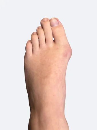 Left foot bunion deformity before surgery