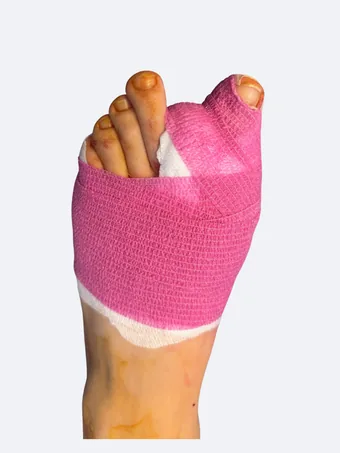 Left foot with post-operative dressing on day of bunion surgery