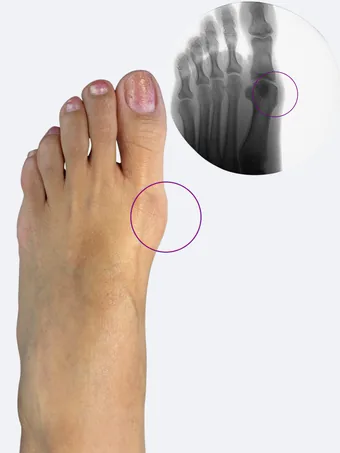 Left foot after bunion correction with X-ray showing improved alignment