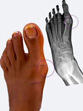 Left foot bunion with X-ray showing metatarsal deviation before surgery