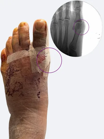 Left foot 48 hours after bunion correction with X-ray showing corrected alignment