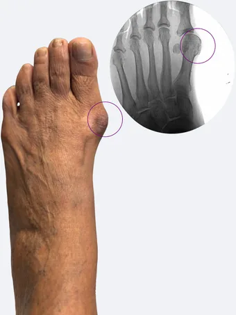 Left foot bunion with pre-operative X-ray showing joint deviation