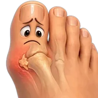 Cartoon foot with painful bone spur bump