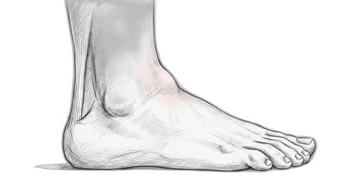 Anterior Tibialis Tendinopathy — Lateral view
