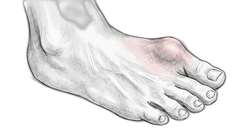 Hallux Valgus (Bunion)
