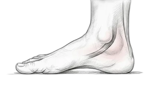 Posterior Tibial Tendon Dysfunction