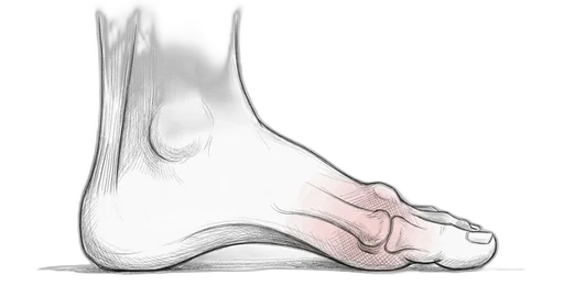 Hallux Rigidus