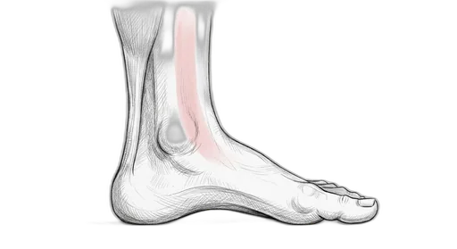 Shin Splints (Medial Tibial Stress Syndrome)