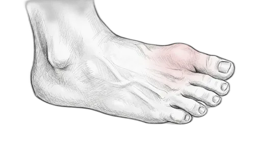 Turf Toe — Dorsal view