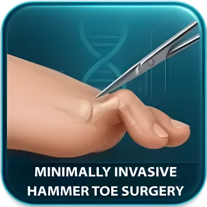 Hammertoe Surgery